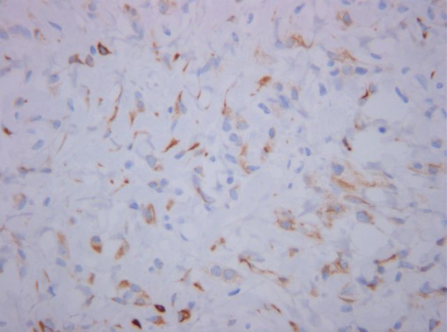 Tincin inmunohistoqumica (Desmina x400) - <div style=